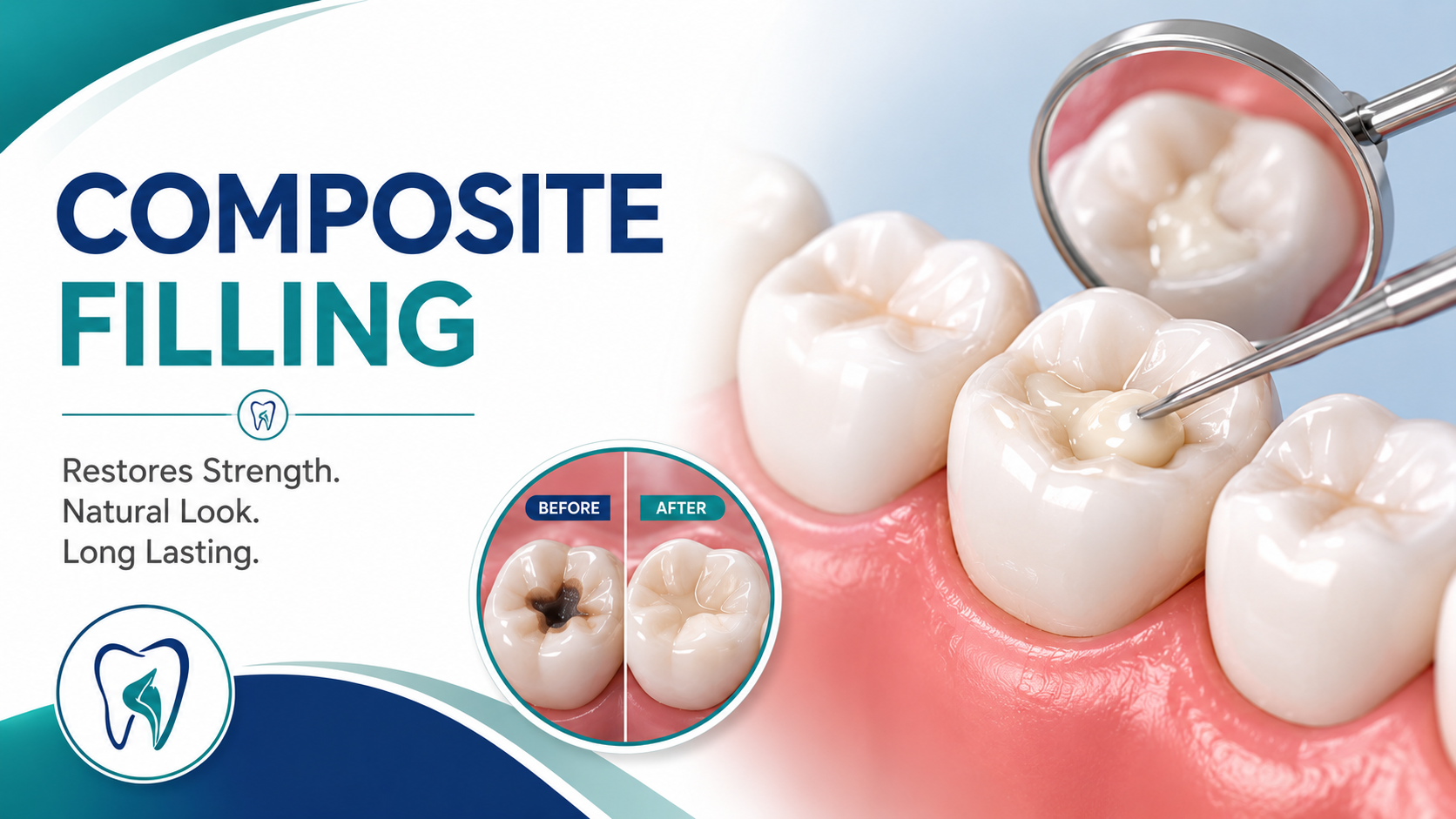 Composite Filling
