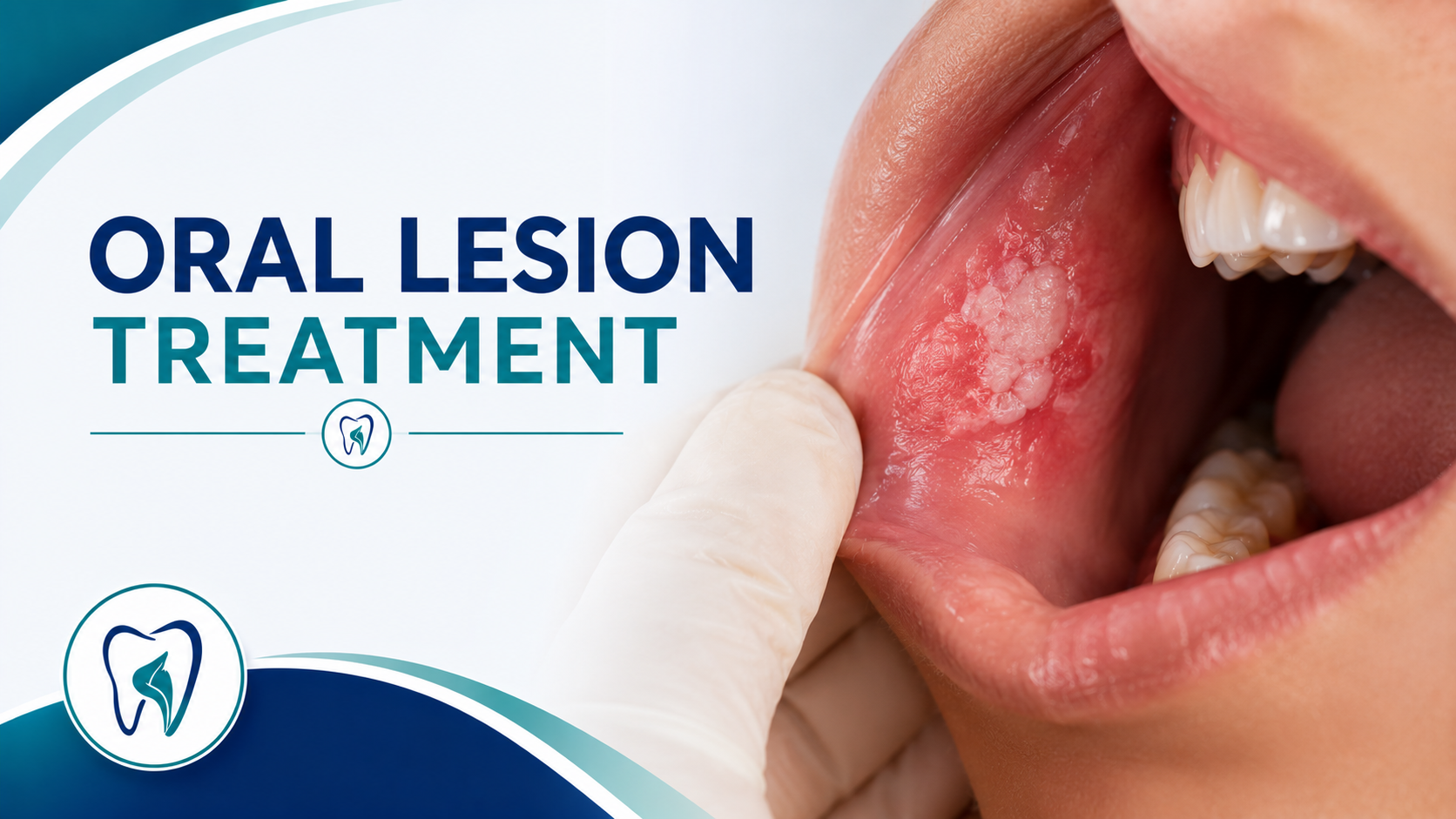 Oral Lesion Treatment