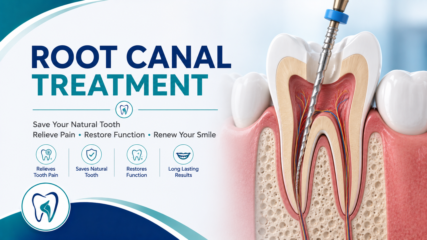 Root Canal Treatment
