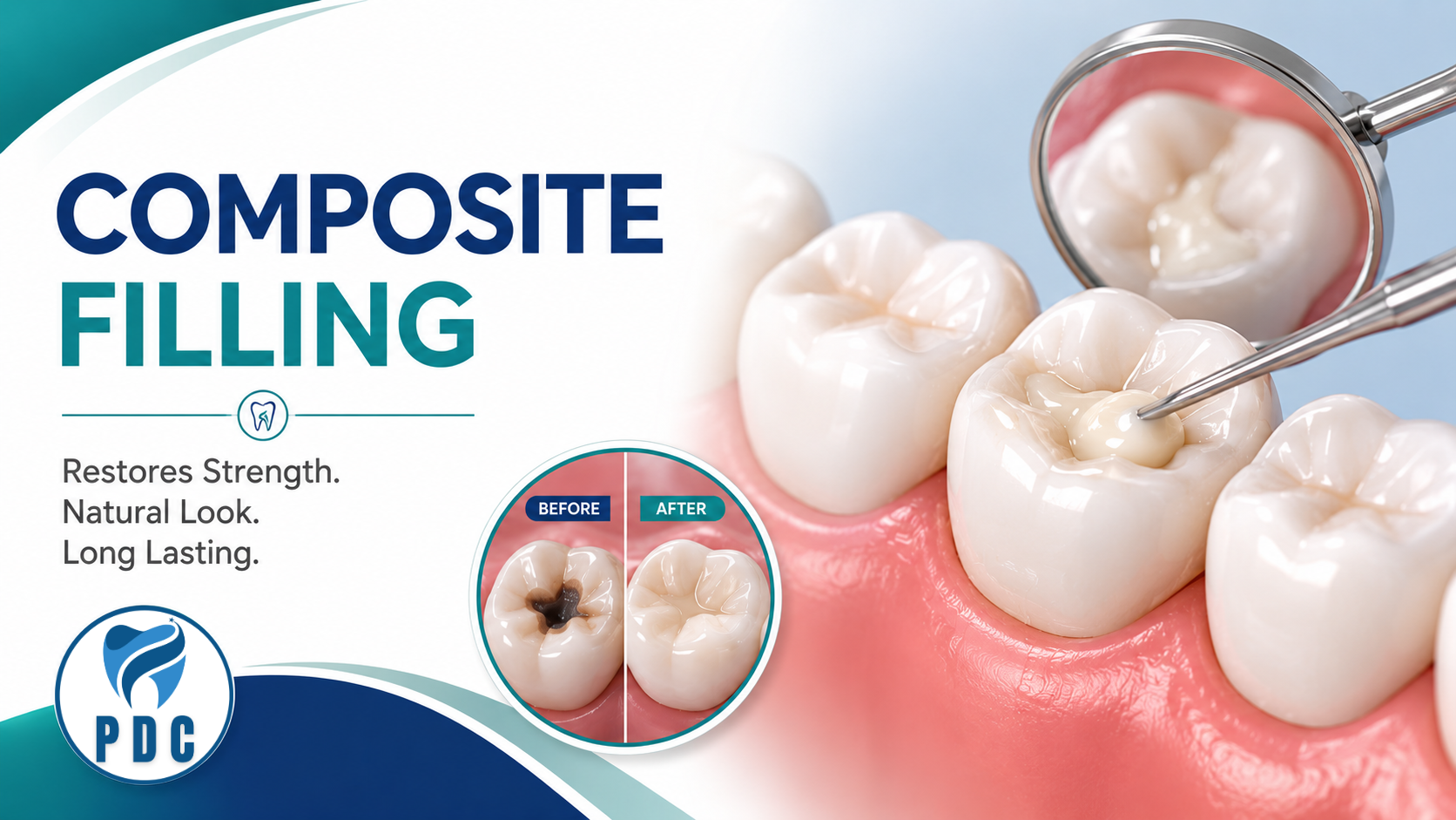 Composite Filling