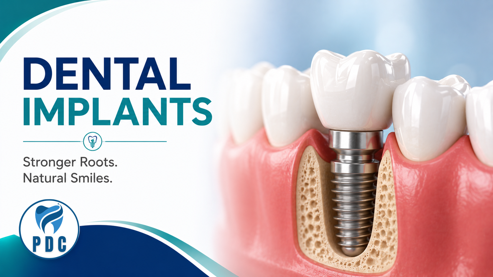 Dental Implants