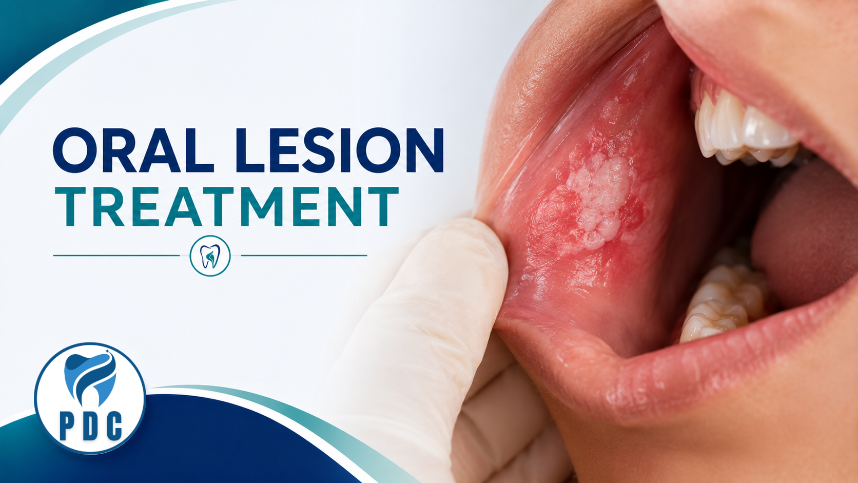 Oral Lesion Treatment