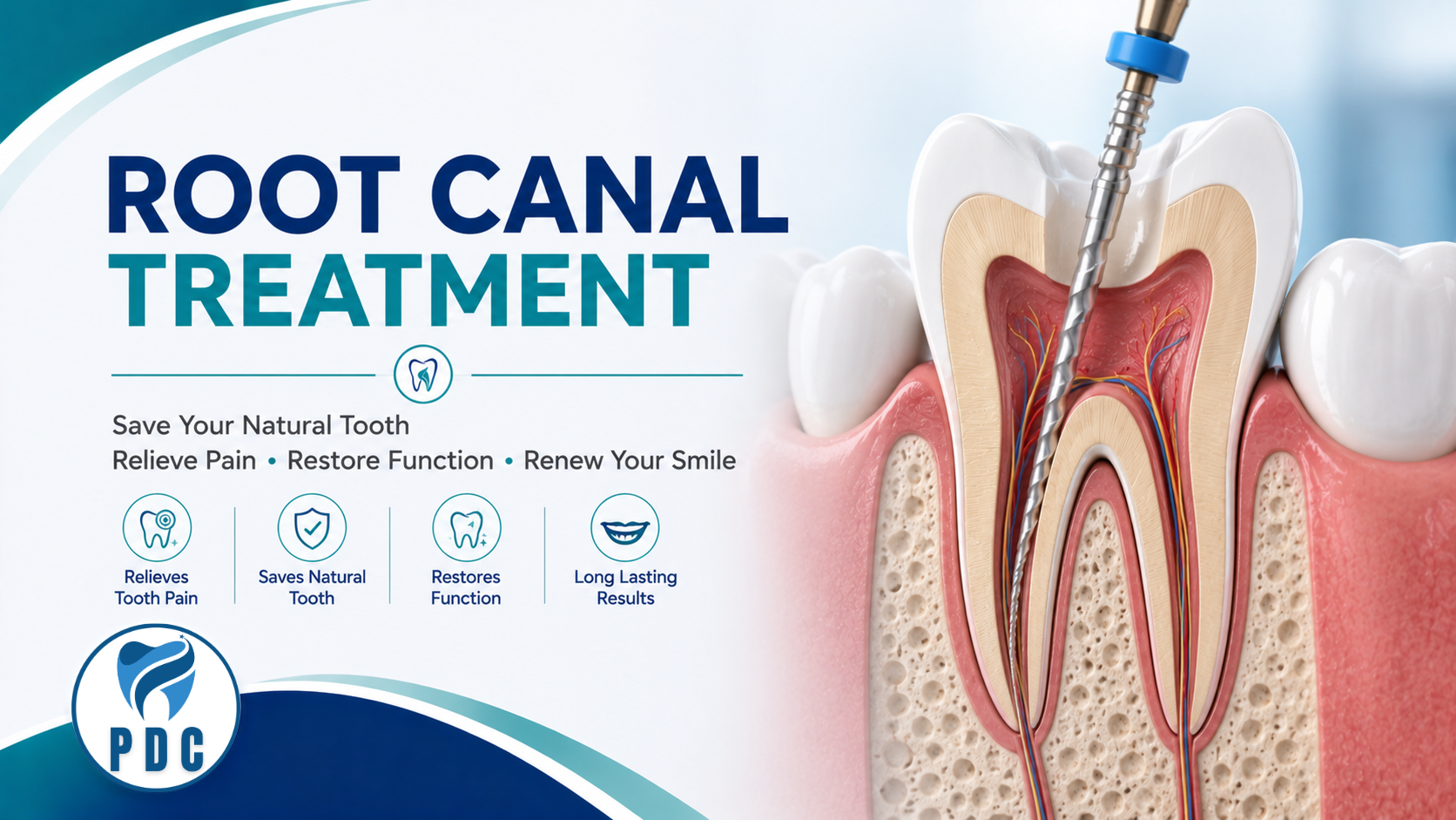 Root Canal Treatment