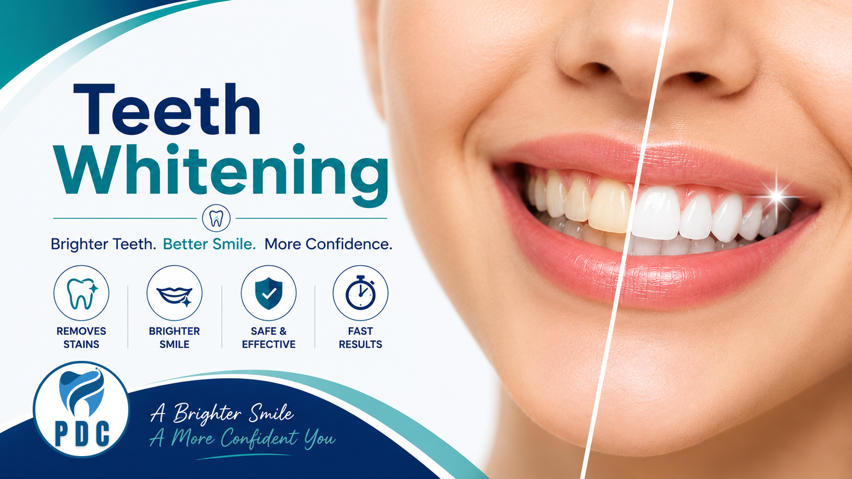 Teeth Whitening