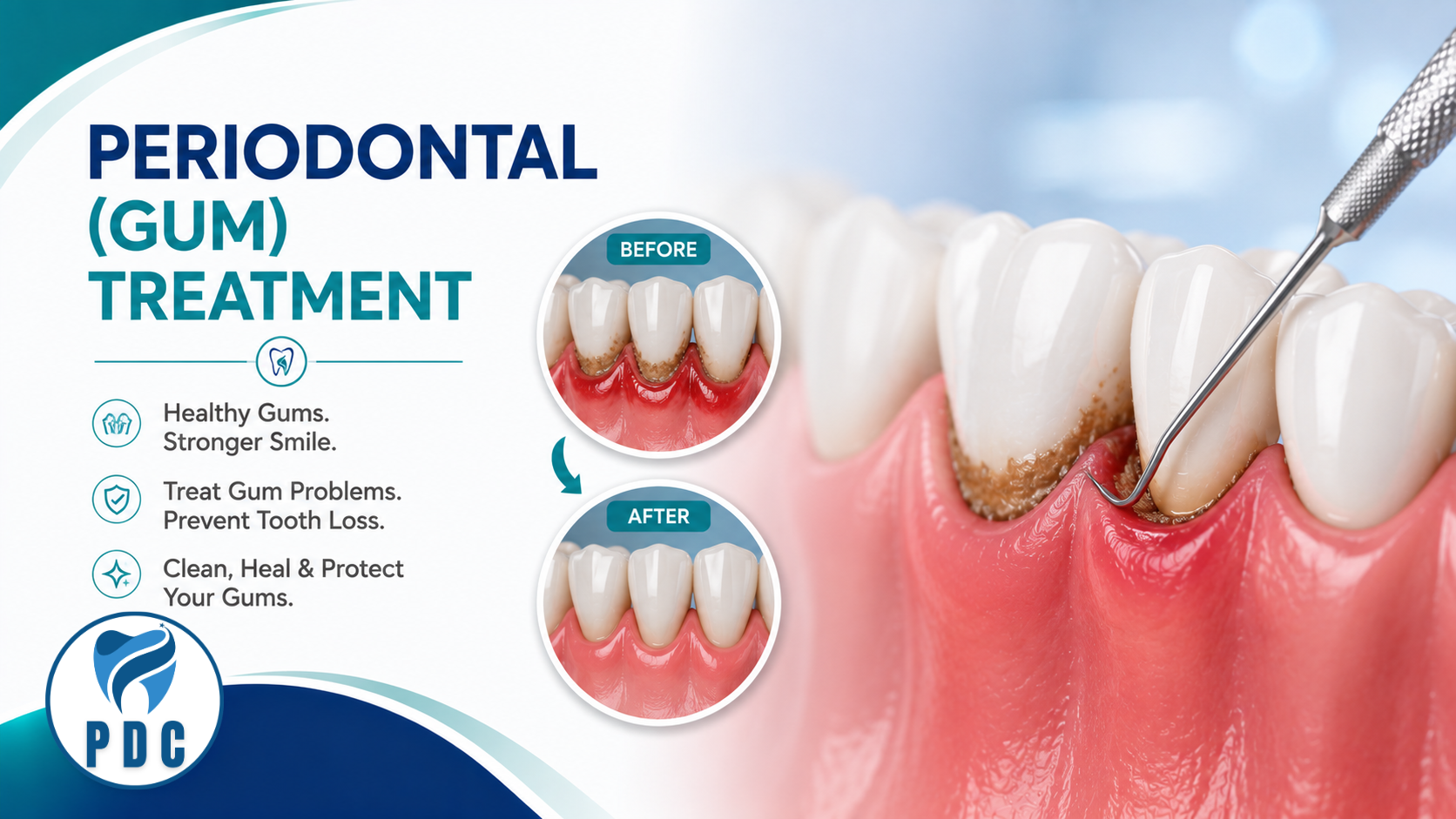 Periodontal (Gum) Treatment